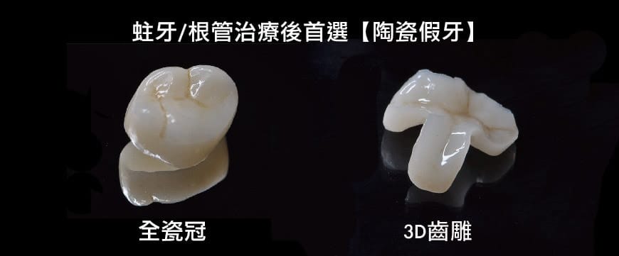 蛀牙 根管治療抽神經後要做假牙牙套嗎 3d齒雕 全瓷冠有什麼優缺點