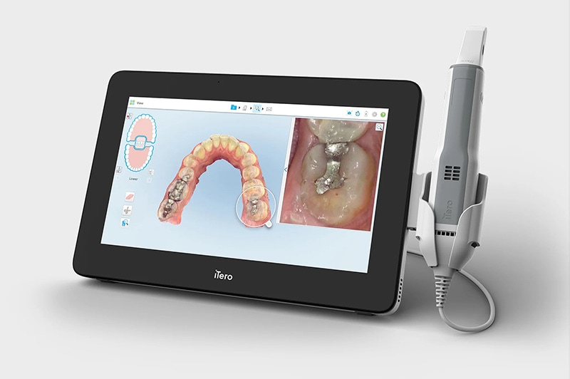 台中品維美學牙醫隱形矯正使用最新的隱適美iTero-5D-plus數位口腔掃描機